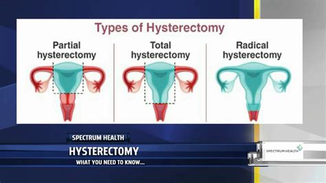 Additionally, there can be <b>internal</b> <b>stitches</b> in an abdominal <b>hysterectomy</b>, as each layer can be closed with a different type of suture. . Symptoms of ruptured internal stitches after hysterectomy